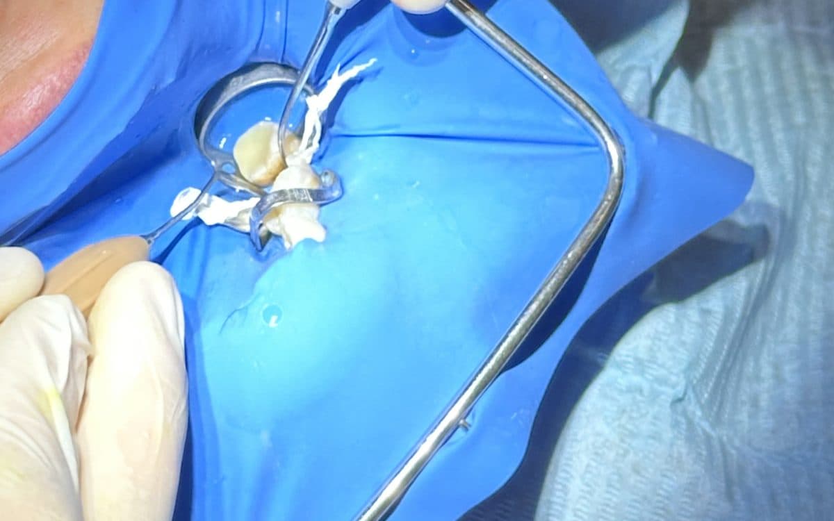 Pieza dental aislada con dique de goma durante una restauración con composite.