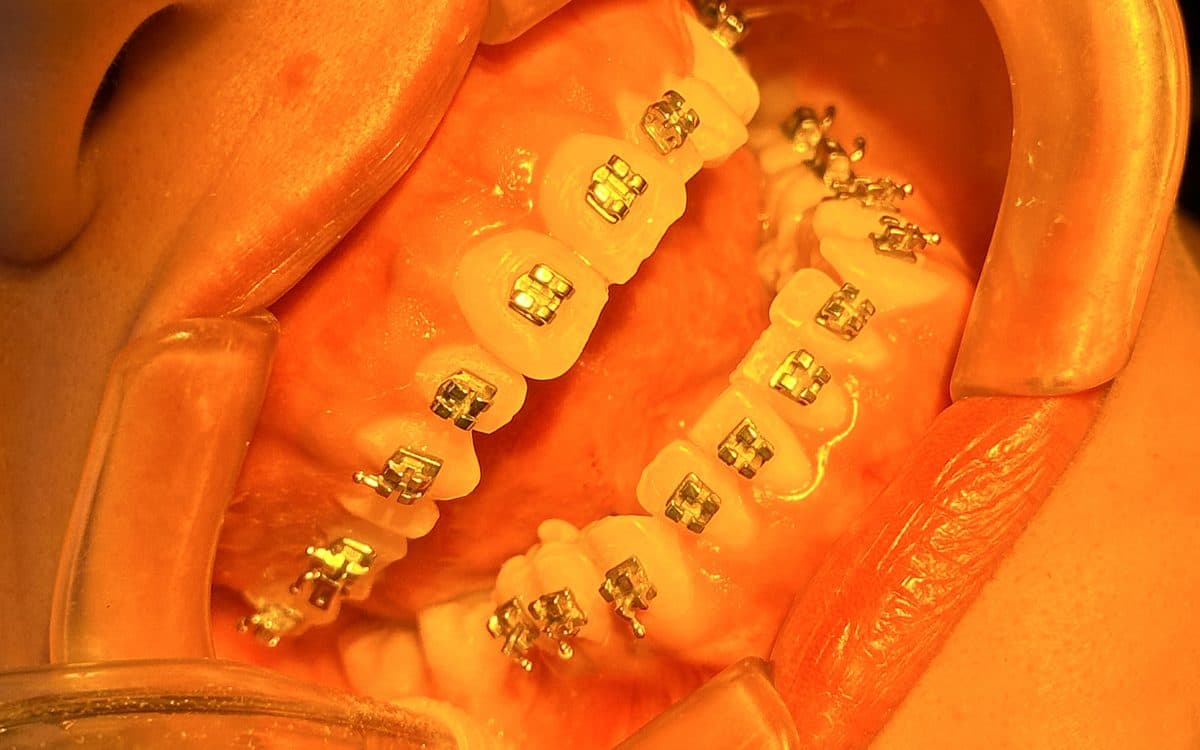 Brackets de ortodoncia colocados en la arcada superior de un paciente de Smile Lab.